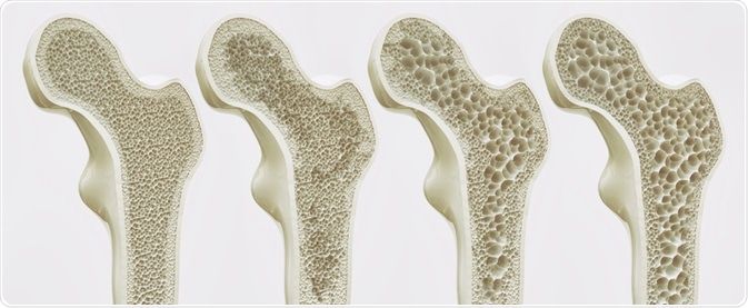 Osteoporose: 4 coisas que você precisa saber!