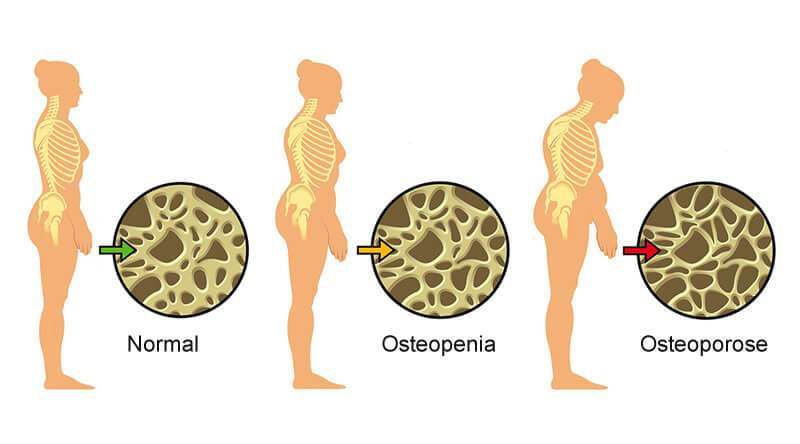 Qual a diferença entre osteopenia e osteoporose? Saiba agora!