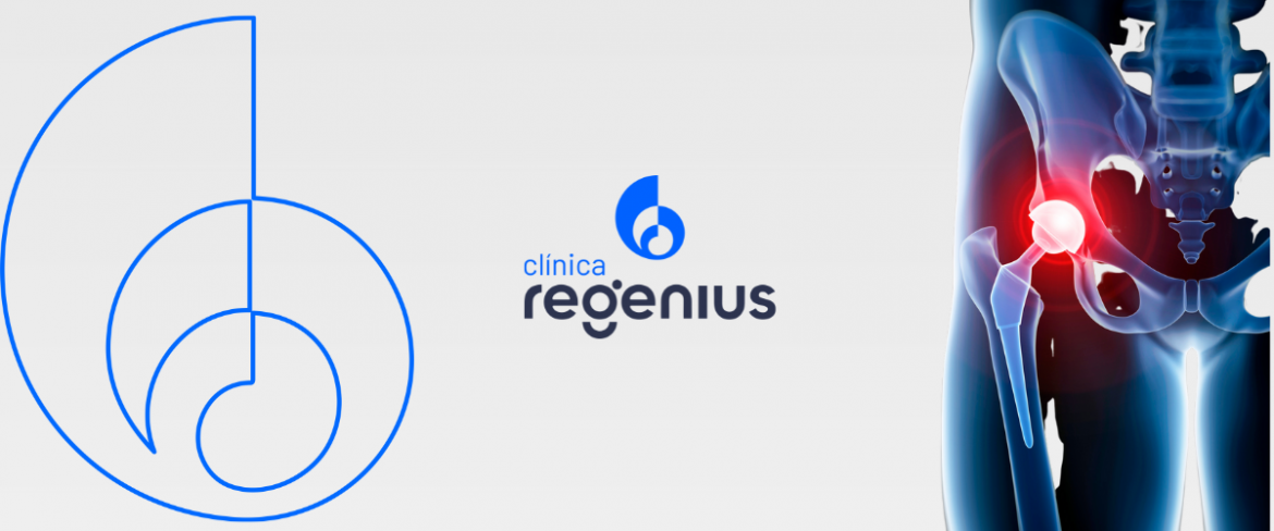 blog clinica regenius (12) Prótese de Quadril